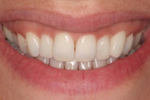 Caso concluso con solo 2 appuntamenti e nessuna preparazione dei denti